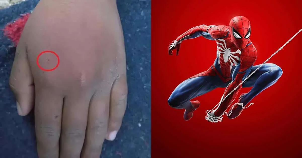 เด็ก 8 ขวบหวิดดับ หลังให้แมงมุมแม่ม่ายดำกัด เพื่อหวังจะได้เป็น Spider-Man