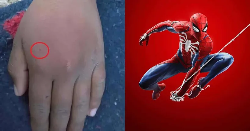เด็ก 8 ขวบหวิดดับ หลังให้แมงมุมแม่ม่ายดำกัด เพื่อหวังจะได้เป็น Spider-Man